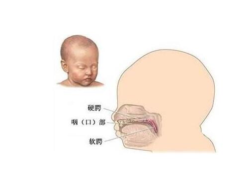 8岁小孩吐字不清的原因是什么也许是腭裂语音障碍